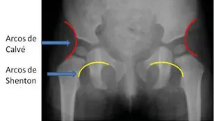 Otra medida utilizada es el índice acetabular ángulo formado por una línea que - фото 99