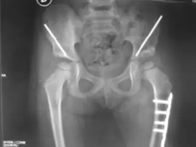En los niños mayores de 6 años el tratamiento es complejo con tasas de - фото 109