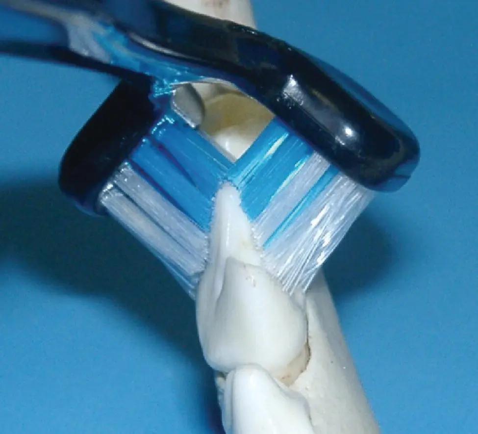 Figure 53 Doubleheaded toothbrushes have certain benefits in plaque control - фото 68