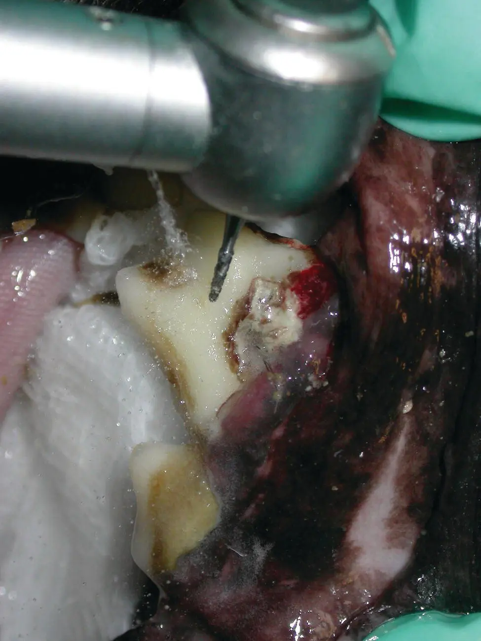 Figure 134 Use of CHX solution during extraction of a badly infected mouth - фото 38