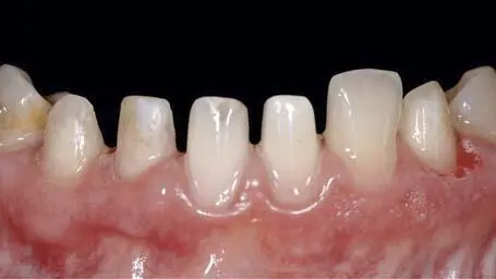 Fig 133d Minimally invasive preparation of 4331 and 33 affected by - фото 124