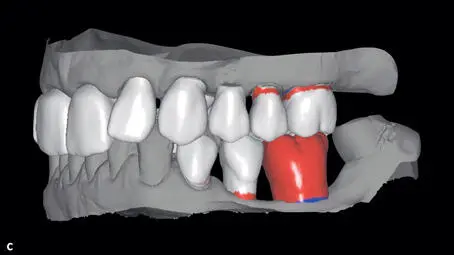 Figs 144a to 144c Three different versions of virtual waxup and setup for - фото 191