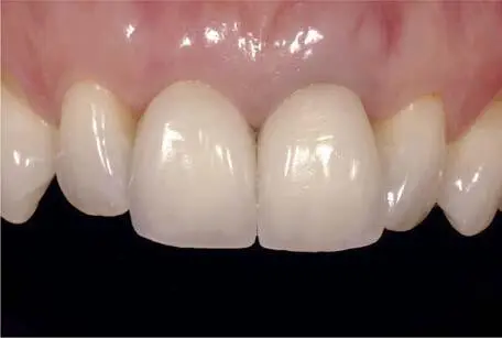 Fig 124 Clinical case example showing the different outcomes of two - фото 82