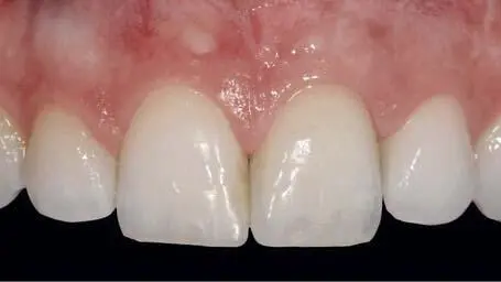 Fig 131d Tooth 21 was restored with a veneered zirconia crown If the teeth - фото 114