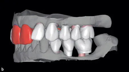 Figs 144a to 144c Three different versions of virtual waxup and setup for - фото 190