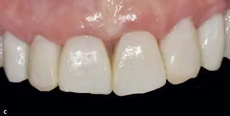 Fixed Restorations - фото 199