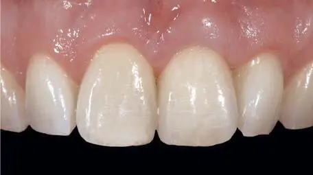 Fig 132d Tooth 21 was restored with a glassceramic implant crown Fig - фото 118