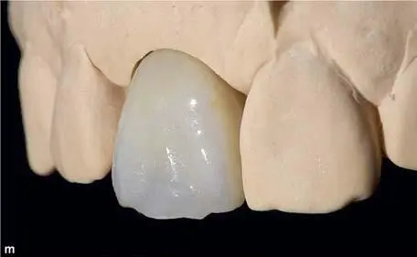Fig 137k to 137n Final view of the microveneered lithiumdisilicate - фото 167