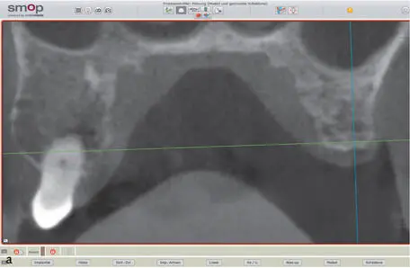 Figs 1410a and 1410b CBCT for the 3D evaluation of the bony situation and - фото 231