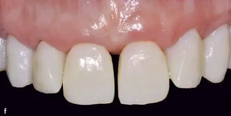 Fixed Restorations - фото 202