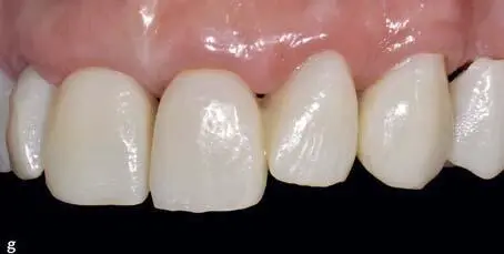 Fixed Restorations - фото 203