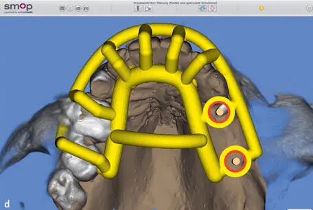 Figs 1412a to 1412d Example of the matching of surface scan data STL of - фото 237
