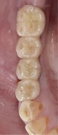 Fig 139d Final view of the superficial individualization Ivocolor Ivoclar - фото 180