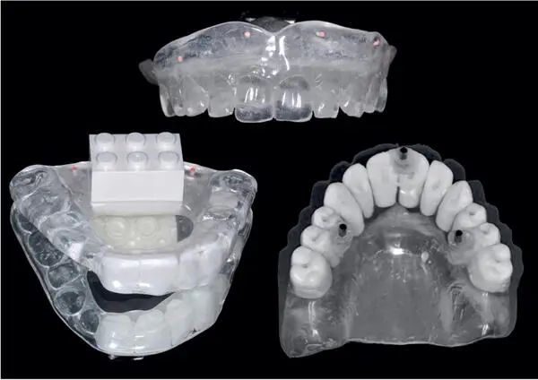 Fig 1411 Laboratory fabricated radiographic templates with radioopaque - фото 233