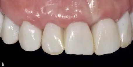 Fixed Restorations - фото 198