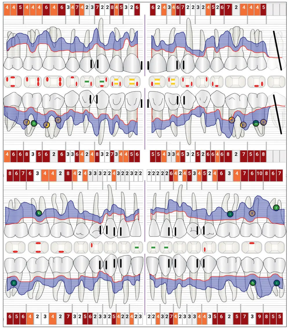 Fig 26Periodontal measurement of the clinical attachment level including - фото 35
