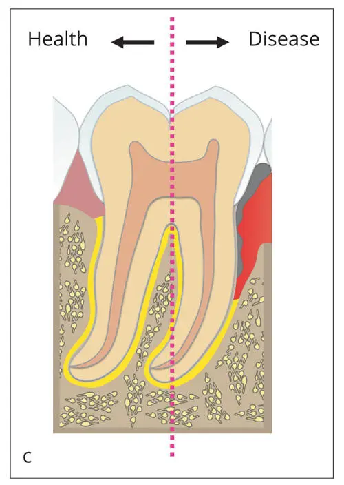 Figs 22a to cPeriodontal Screening Index PSI a Periodontal conditions are - фото 23