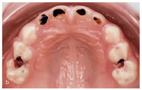 Figs 11a and bCaries is nowadays understood as an imbalance between de and - фото 4