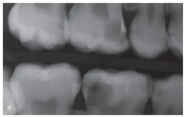 Figs 16a and bBitewing radiographs a allow a staging of proximal lesions and - фото 16