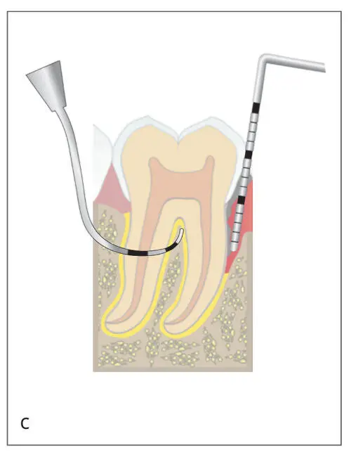 Figs 23a to cFor a complete periodontal examination more precisely scaled - фото 26