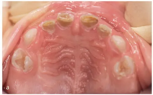 Figs 11a and bCaries is nowadays understood as an imbalance between de and - фото 3
