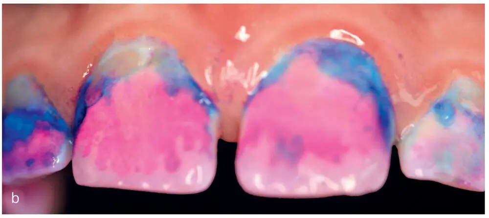 Figs 15a to cMaxillary anterior teeth a before plaque removal b after - фото 14