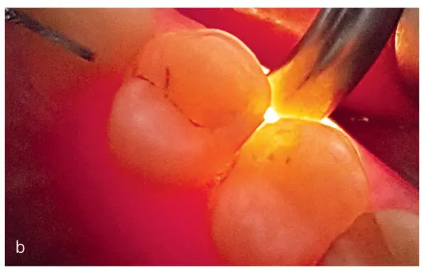 Figs 16a and bBitewing radiographs a allow a staging of proximal lesions and - фото 17