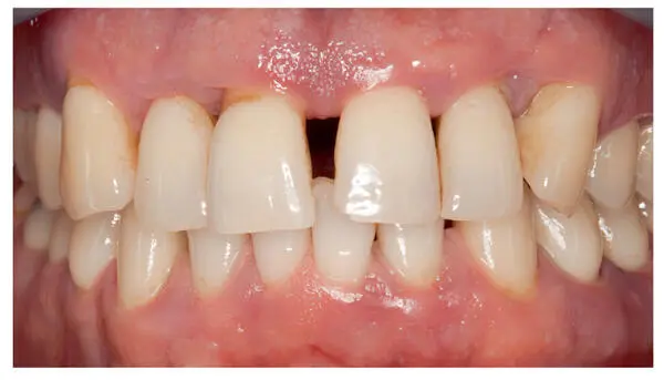 Fig 21Representative image of a patient with periodontitis This image shows - фото 20