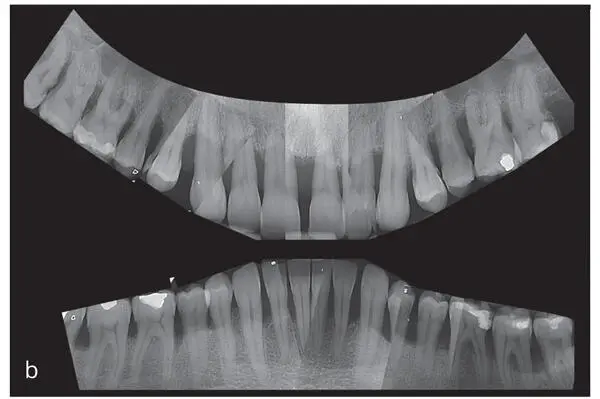 Figs 25a and bRadiographic examination of the patient introduced in Fig 23 - фото 34
