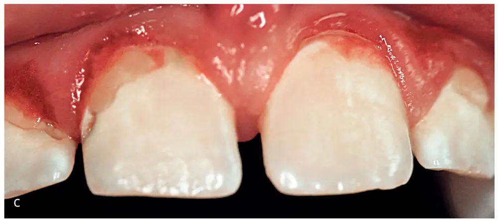Figs 15a to cMaxillary anterior teeth a before plaque removal b after - фото 15
