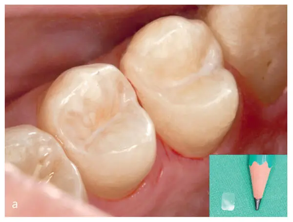 Figs 17a and bMinimally invasive treatment of approximal initial caries - фото 18