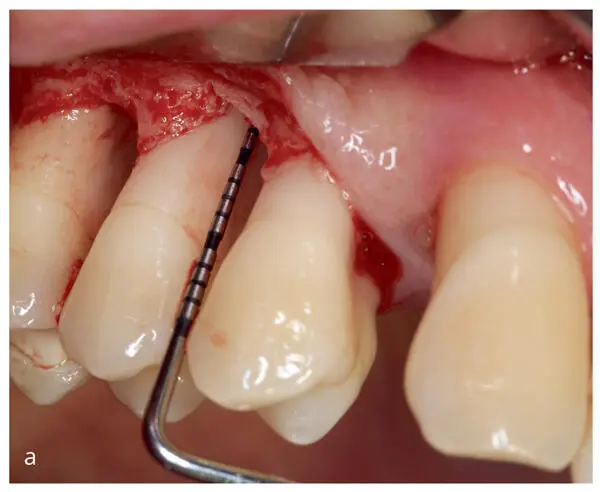 Innovations in Preventive Dentistry - фото 36