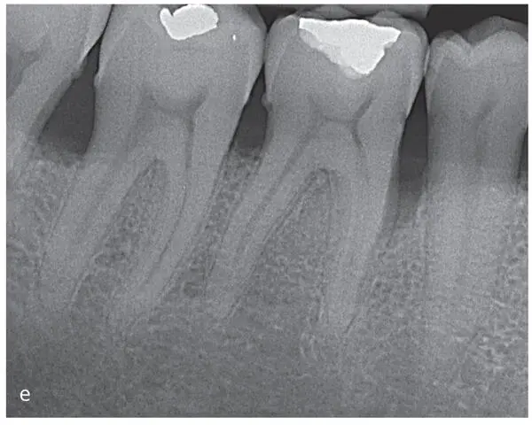 Figs 29a to fRadiographic images of the therapeutic outcome 2 years after - фото 49