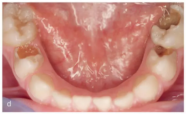 Figs 13a to dA large percentage of children are cariesfree 80 a and b - фото 10