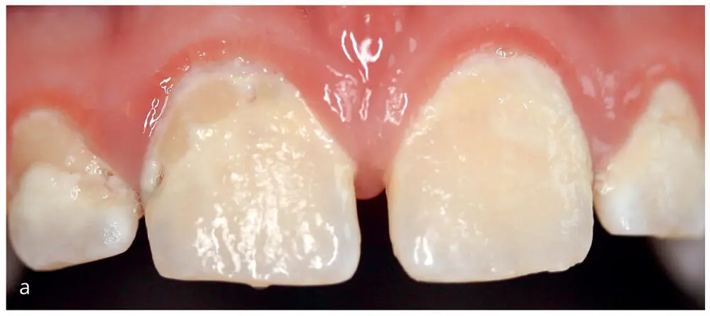 Figs 15a to cMaxillary anterior teeth a before plaque re - фото 13