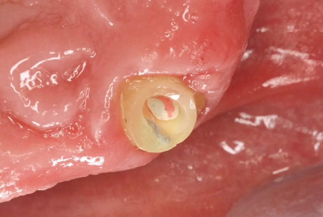Abb 6Der frakurierte Stumpf 23 nach endodontischer Versorgung Abb 7Zahn - фото 137