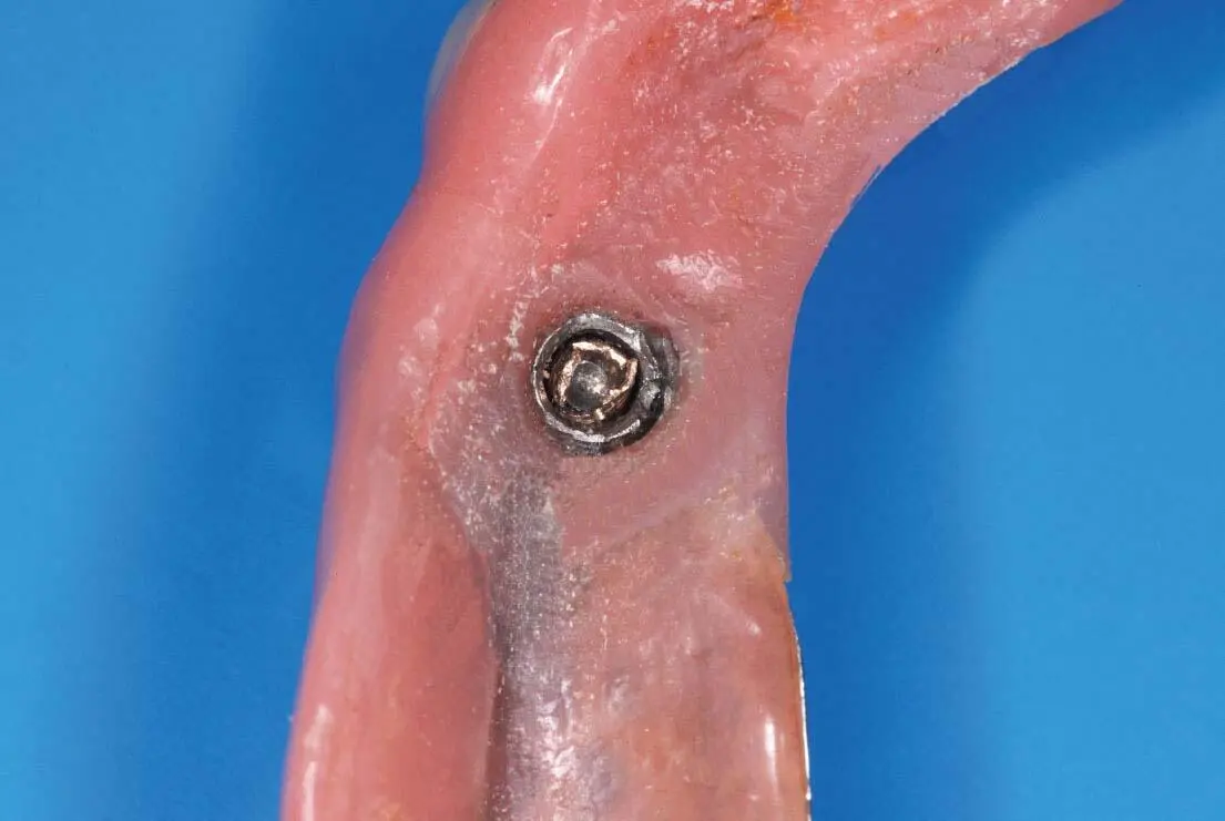 Abb 3Abgenutzter unbrauchbarer Kugelkopfanker auf Implantat Regio 23 - фото 346