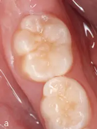 MolarenInzisivenHypomineralisation - фото 17