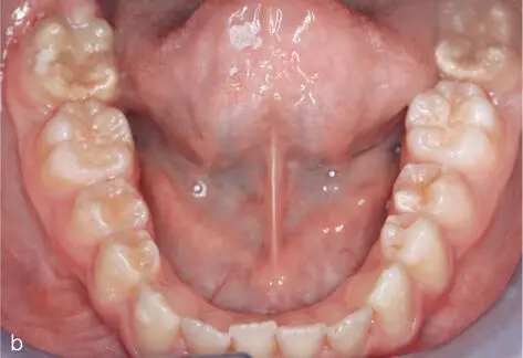 Abb 220 12jähriger Patient mit hypomineralisiertem zweitem Molaren in - фото 63