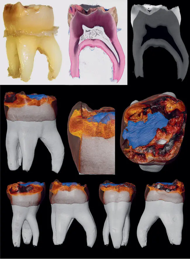 Abb 36 Molar mit MIHLäsion im klinischen Bild als Dünnschliffpräparat unter - фото 75