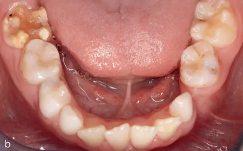 Abb 216 Differente Erscheinungen der Hypomineralisation an den oberen und - фото 58