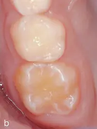 MolarenInzisivenHypomineralisation - фото 49