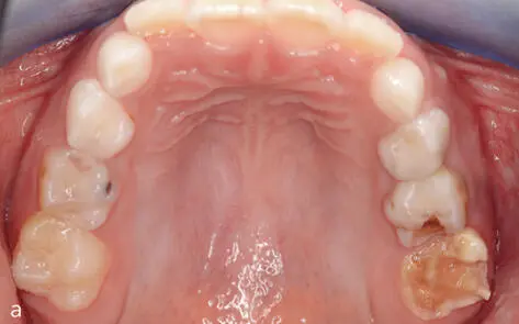 Abb 216 Differente Erscheinungen der Hypomineralisation an den oberen und - фото 57