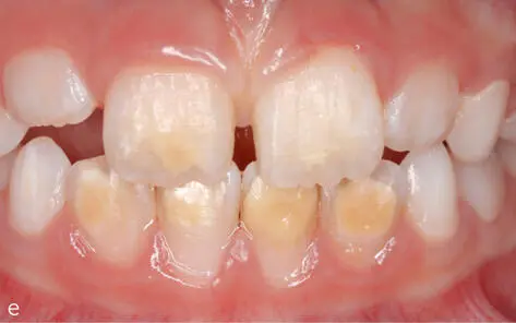 Abb 29 Inzisiven von MIHPatienten mit Hypomineralisationen - фото 38