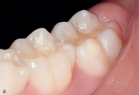 Abb 27 Unterschiedliche Lokalisationen der Hypomineralisation - фото 29
