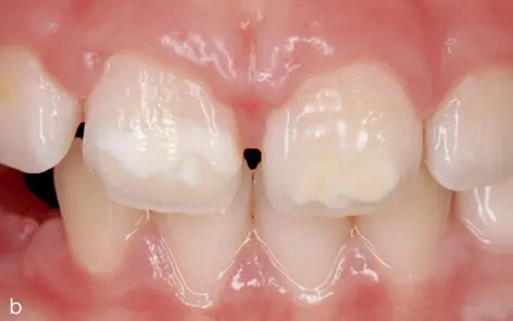 MolarenInzisivenHypomineralisation - фото 35