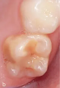 Abb 27 Unterschiedliche Lokalisationen der Hypomineralisation a Zahn 36 mit - фото 30