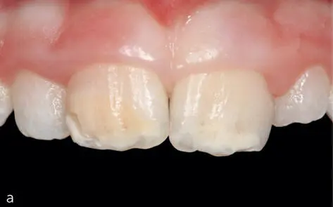 Abb 26 Posteruptive Schmelzeinbrüche an hypomineralisierten Inzisiven a - фото 27