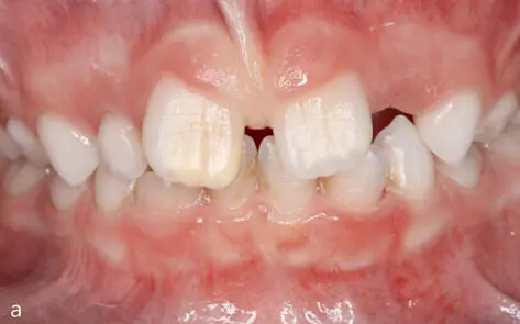Abb 212 65jähriger MIHPatient mit Opazitäten an den Molar - фото 45