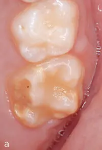 MolarenInzisivenHypomineralisation - фото 23